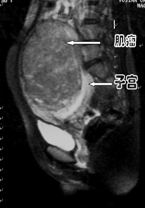 子宫肌瘤介入微创治疗