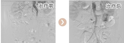 下肢动脉硬化症手术对比图