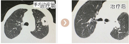 手术治疗前后对比图